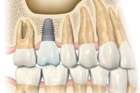 illustration of dental implant