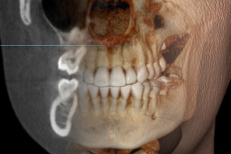 Cone Beam CT radiograph