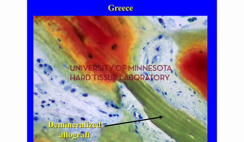 Greece Demineralized allograft