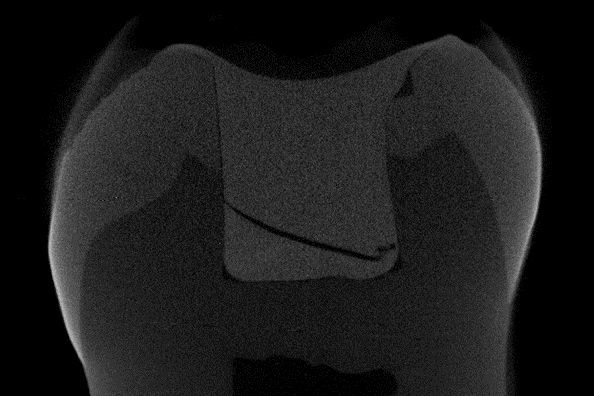 Characterization of Dental Material
