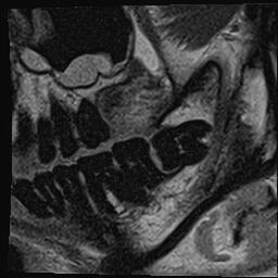 Proton density image of horizontally impacted tooth