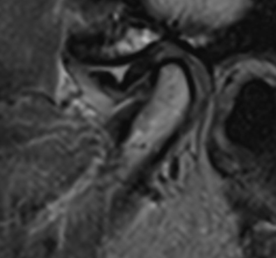 Proton density image of TMJ demonstrating anterior disc displacement, disc fold, and joint effusion