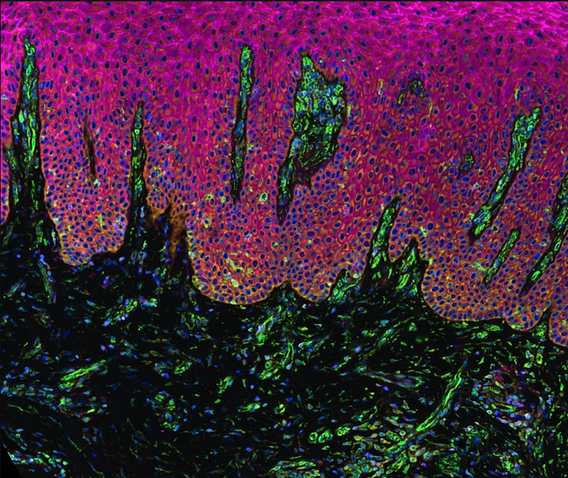 inflamed gingival tissue from a periodontitis subject, spotlighting an understudied interface between the oral epithelium's basal keratinocytes and the underlying stroma.
