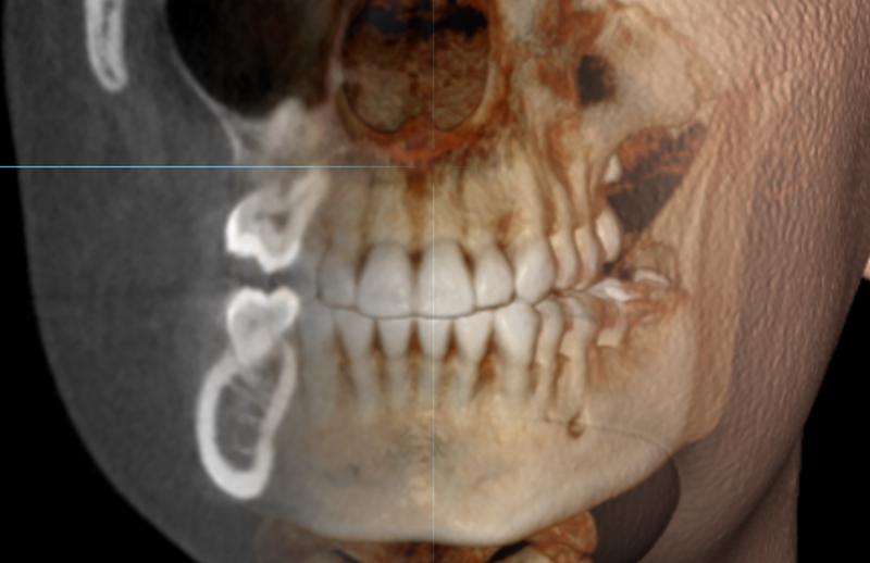 Cone Beam CT radiograph